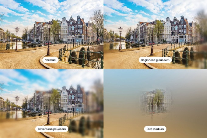 Vier dezelfde foto's van een brug en enkele historische panden aan een gracht in Amsterdam. De eerste is normaal, dus zonder glaucoom. Bij de tweede is aan de zijkanten enige vervaging te zien, wat beginnend glaucoom is. Bij de derde foto zijn alleen enkele van de panden nog scherp en is alles eromheen vaag. Bij de vierde en laatste zie je nog wel wat van de panden, maar is alles eromheen onzichtbaar in een soort mist.